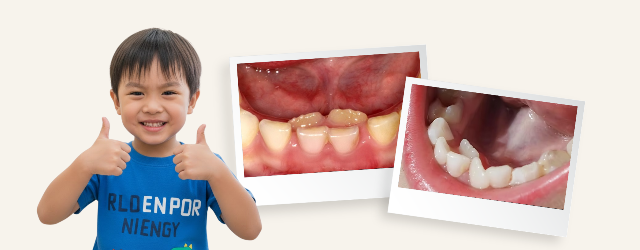 Gigi Susu Anak Tumpang Tindih, Perlu Khawatirkah?