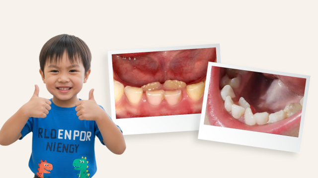 Gigi Susu Anak Tumpang Tindih, Perlu Khawatirkah?