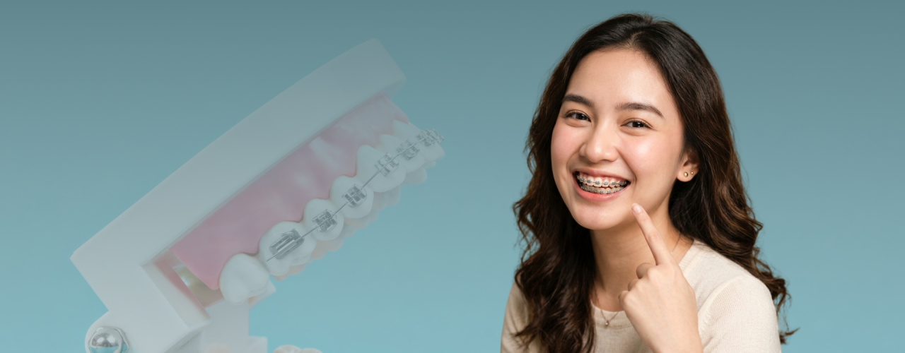 4 Alasan Mengapa Behel Tidak Hanya Membuat Gigi Rapi, Tetapi Juga Menjaga Kesehatan Gigi