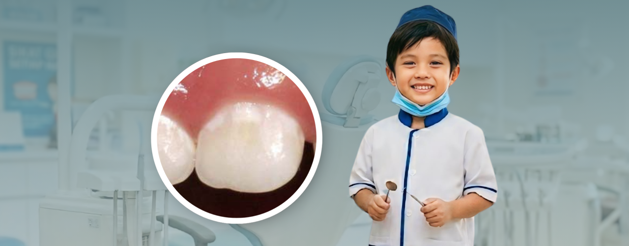 White Spot Lesion pada Gigi Anak: Kenali Tanda Awal Gigi Berlubang