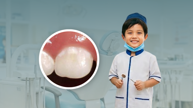 White Spot Lesion pada Gigi Anak: Kenali Tanda Awal Gigi Berlubang