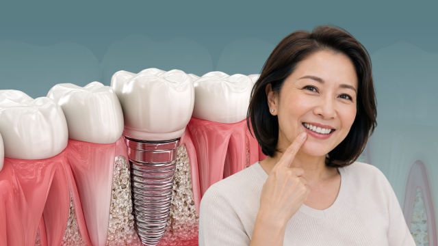 Dental Implant: Solusi Modern untuk Menggantikan Gigi yang Hilang