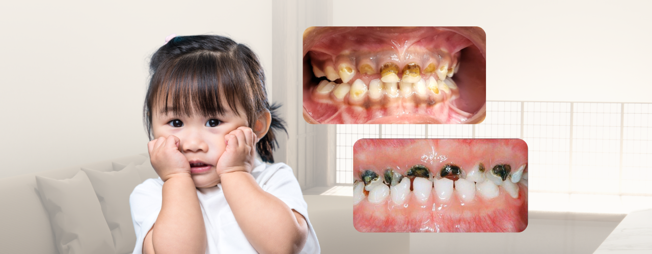 Orang tua wajib tahu! Kebiasaan yang Bisa Bikin Gigi Anak Rusak