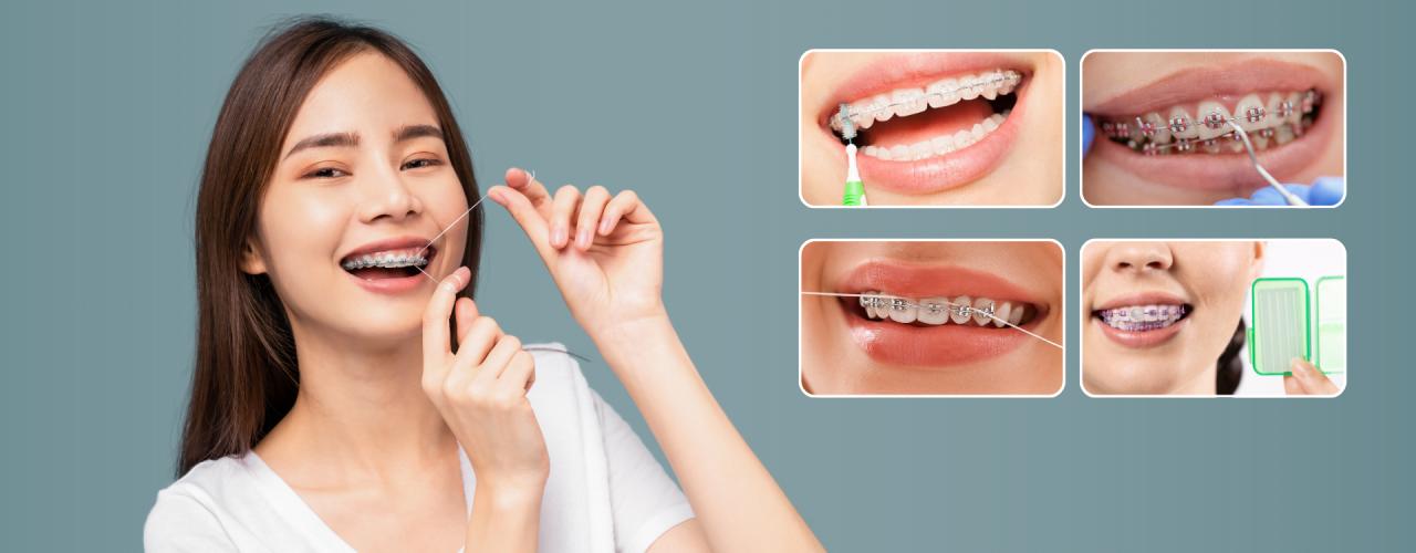 Tips Merawat Gigi dengan Behel