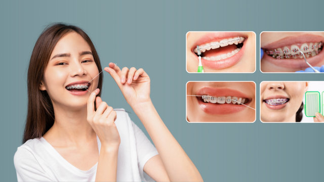 Tips Merawat Gigi dengan Behel