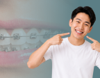 Mengenal Behel Self-Ligating: Perawatan Ortodonti Tanpa Karet Elastis
