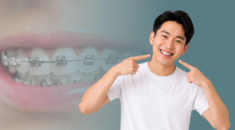 Mengenal Behel Self-Ligating: Perawatan Ortodonti Tanpa Karet Elastis