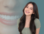 Dental Veneers: Solusi untuk Senyum Lebih Rapi, Cerah, dan Natural
