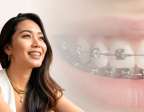 Damon System: Behel Modern untuk Senyum Lebih Rapi!