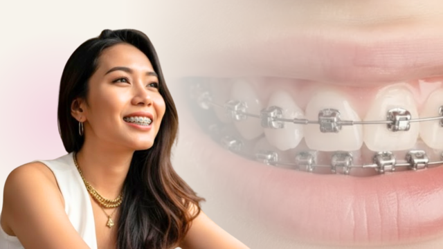 Damon System: Behel Modern untuk Senyum Lebih Rapi!